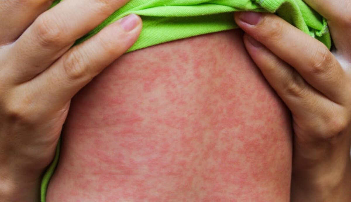 Автор фото: Латвийский национальный Центр профилактики и контроля заболеваний (SPKC). Сыпь на теле ребёнка, заболевшего корью.