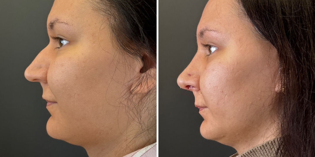 Ринопластика: 9 дней после операции