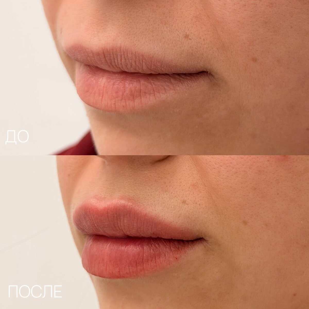 Результаты процедуры контурной пластики губ