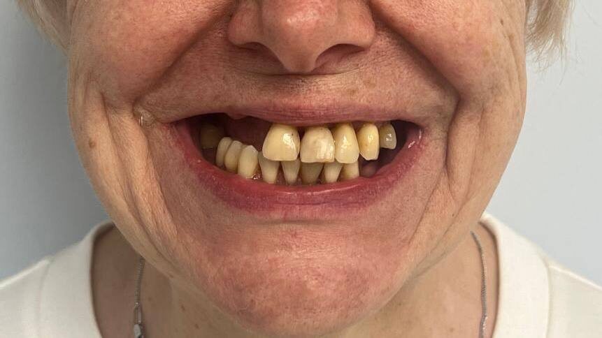 С такой ситуацией пациентка обратилась к нам: сильная подвижность зубов и износ старых конструкций