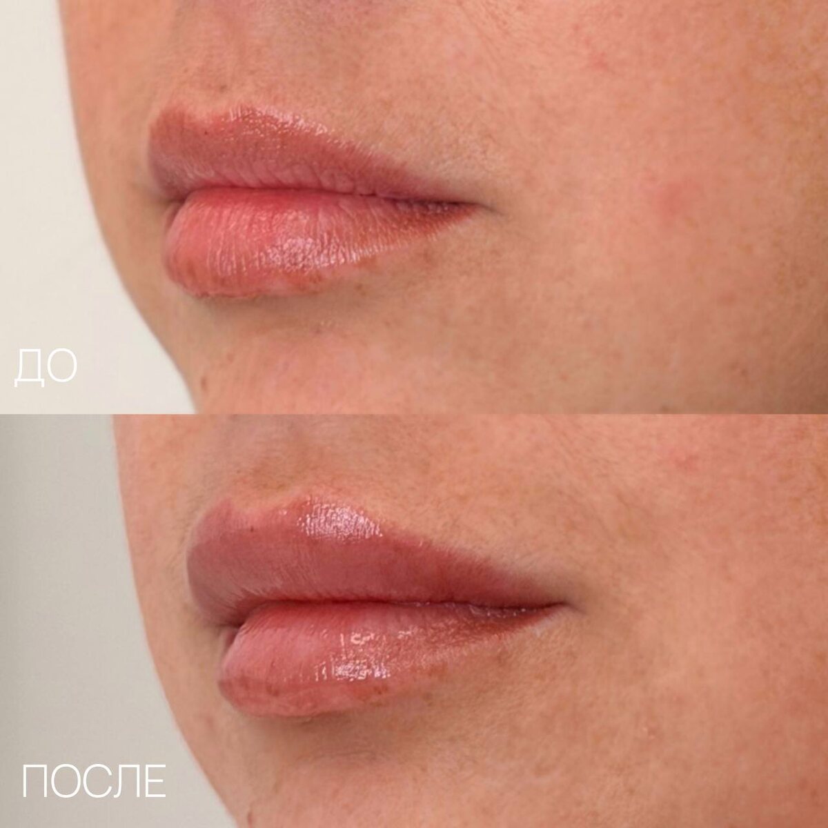 Результат процедуры бьютификации губ