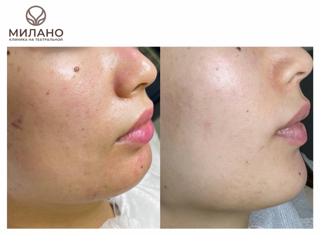 Улучшение состояния кожи при правильно подобраном домашнем уходе