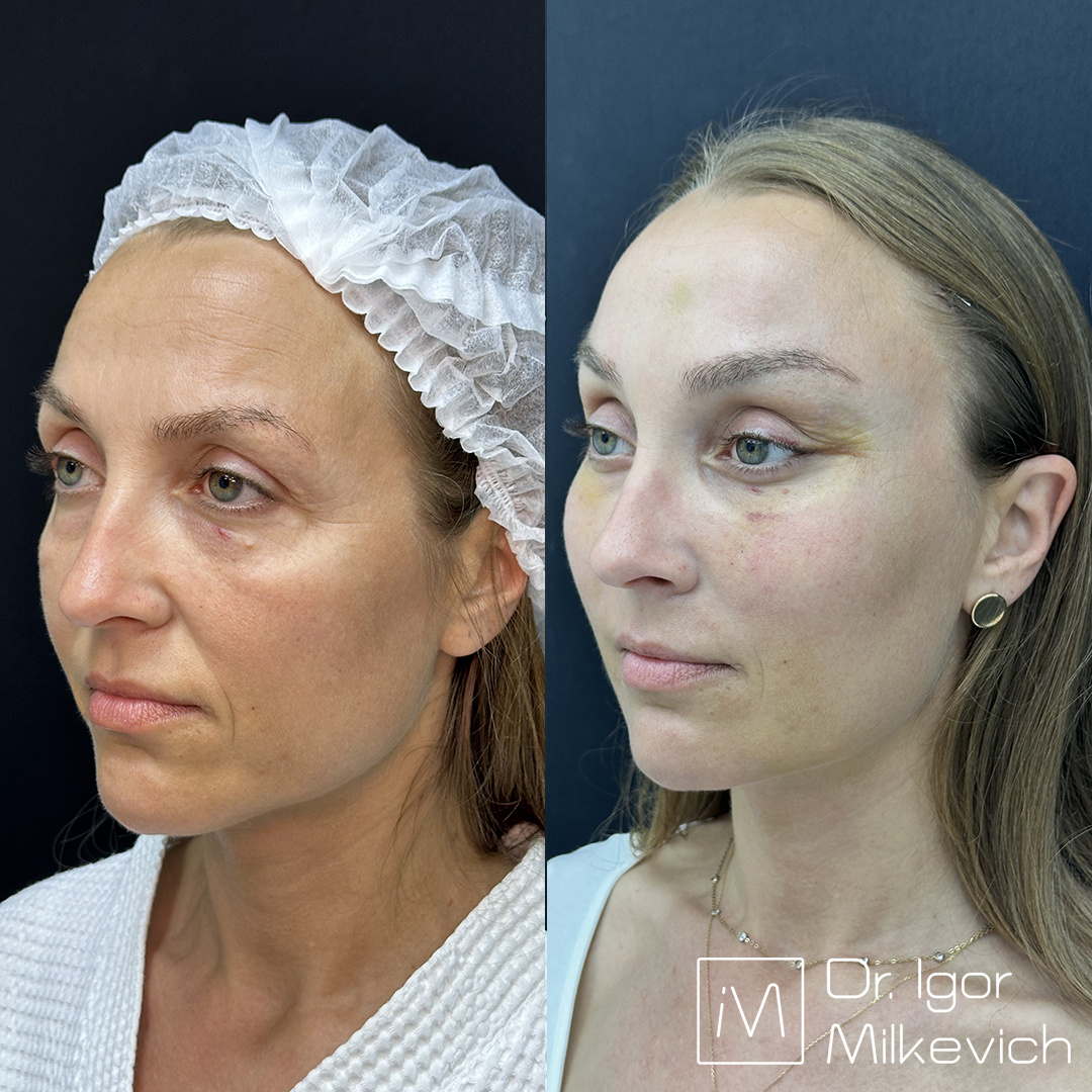 7 дней после операции. Пациентка сразу после этого осмотра улетела к себе домой. На этом этапе еще есть гиперкоррекция в области век. 