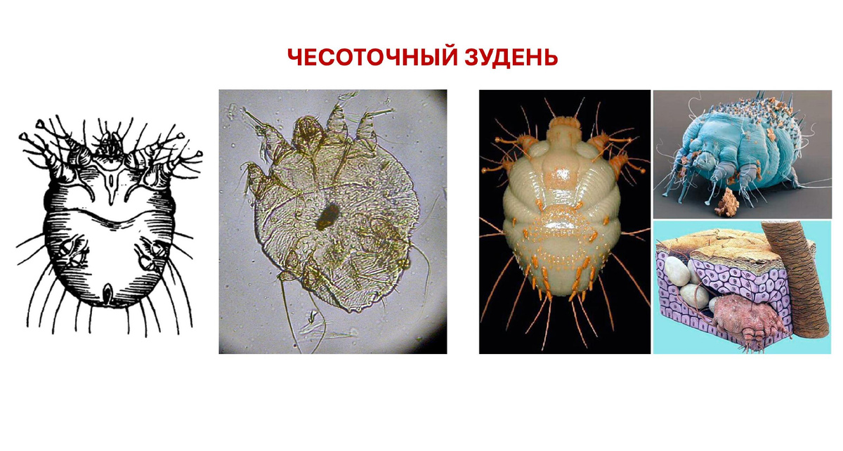 Давайте вспомним, как выглядит прекрасный чесоточный клещ. Я напомниаю, что в ЕГЭ у нас мноооооооого картинок)) 

Этот товарищ вполне может оказаться в чьем-нибудь КИМе. Так что не игнорим. 

✍️ фиксируем самое важное

_____________

ЧЕСОТКА

• Возбудитель - чесоточный зудень (клещ). Размер около 0,3–0,5 мм.

Самки внедряются в роговой слой кожи, 
прогрызают ходы и откладывают яйца.

Самцы живут на поверхности кожи
и после оплодотворения погибают.

• Симптомы: сильный зуд (усиливается ночью), мелкая сыпь, пузырьки, расчёсы, характерные чесоточные ходы (тонкие сероватые линии на коже).

• Пути заражения: тесный телесный контакт, использование общего белья, одежды, полотенец.

• Профилактика: соблюдение личной гигиены, избегание контакта с больными,  стирка и проглаживание белья,  своевременное обращение к врачу.