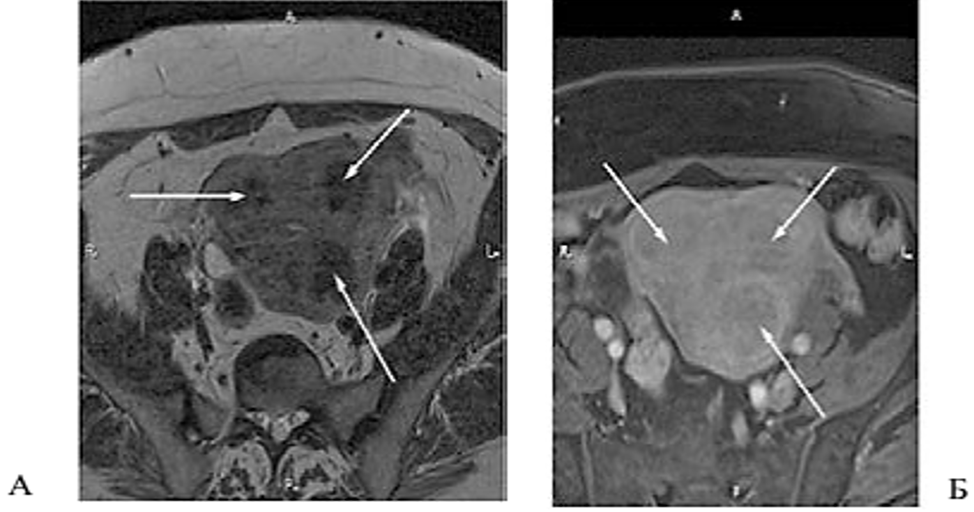 Рис. 1. Больная Н., 58 лет. Множественные лейомиомы матки. Аксиальные срезы через тело матки. А.Т2-ВИ; Б.Т1-ВИ с жироподавлением после введения контрастного препарата. Стрелками указаны лейомиомы матки с признаками гиалиновой дегенерации, характеризующиеся гипоинтенсивным МР-сигналом на Т2-ВИ (А), при введении контрастного препарата (Б) определяется его умеренное равномерное накопление узлами с образованием гиперинтенсивного ободка по периферии образований — псевдокапсулы.