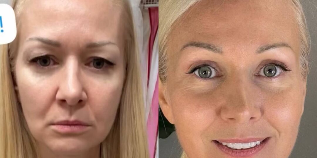 БЛЕФАРОПЛАСТИКА: надо ли обрезать веки и какие есть альтернативы?