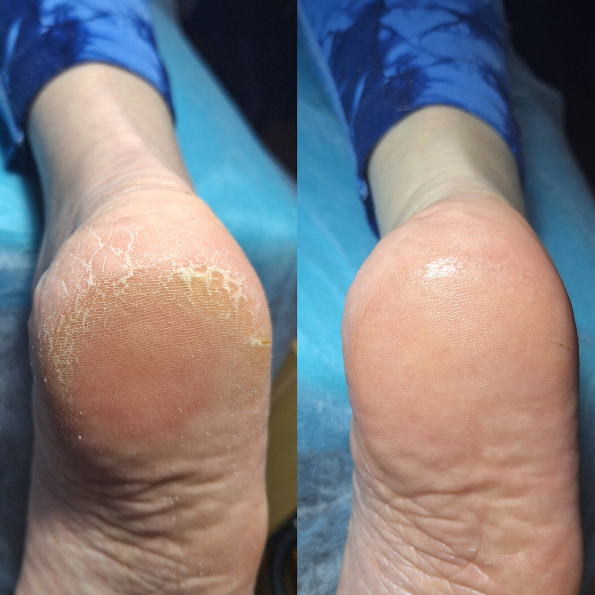 До — сухость, мозоли и "я устала, я ухожу".После — нежность, гладкость и "можно целовать, но лучше просто обувать красивые туфли".