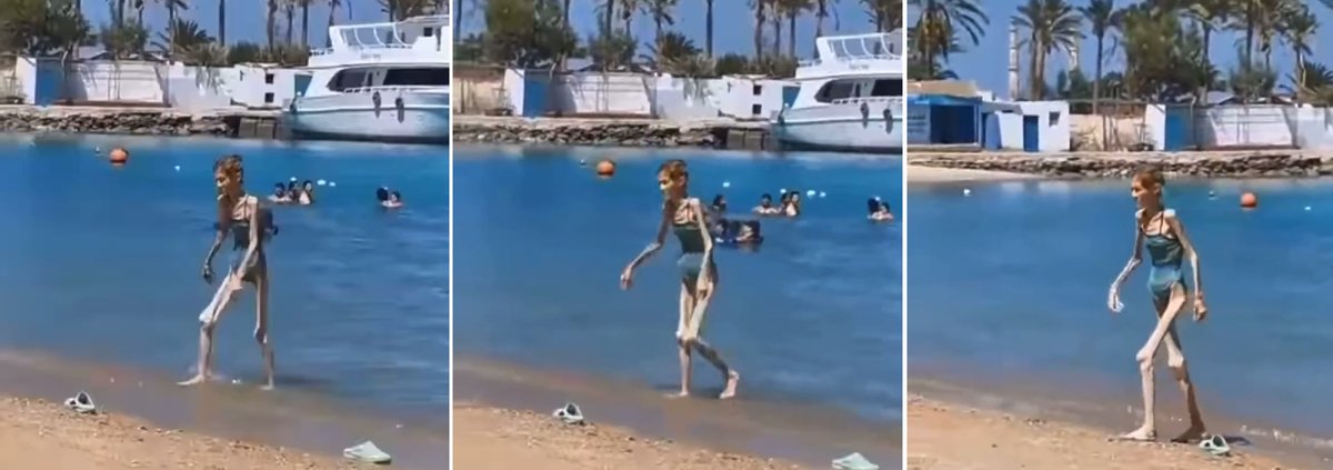 Тяжелая стадия анорексии