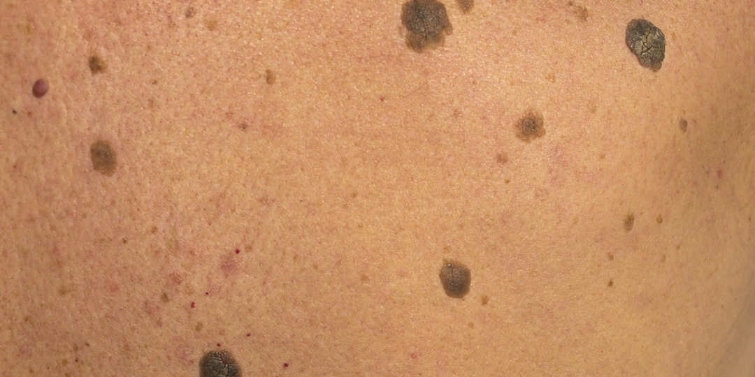 Врачи назвали признак на коже, который может быть связан с опухолью