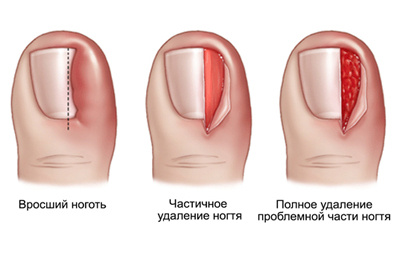 Вросший ноготь: как избавиться от боли и вернуть комфорт каждому шагу