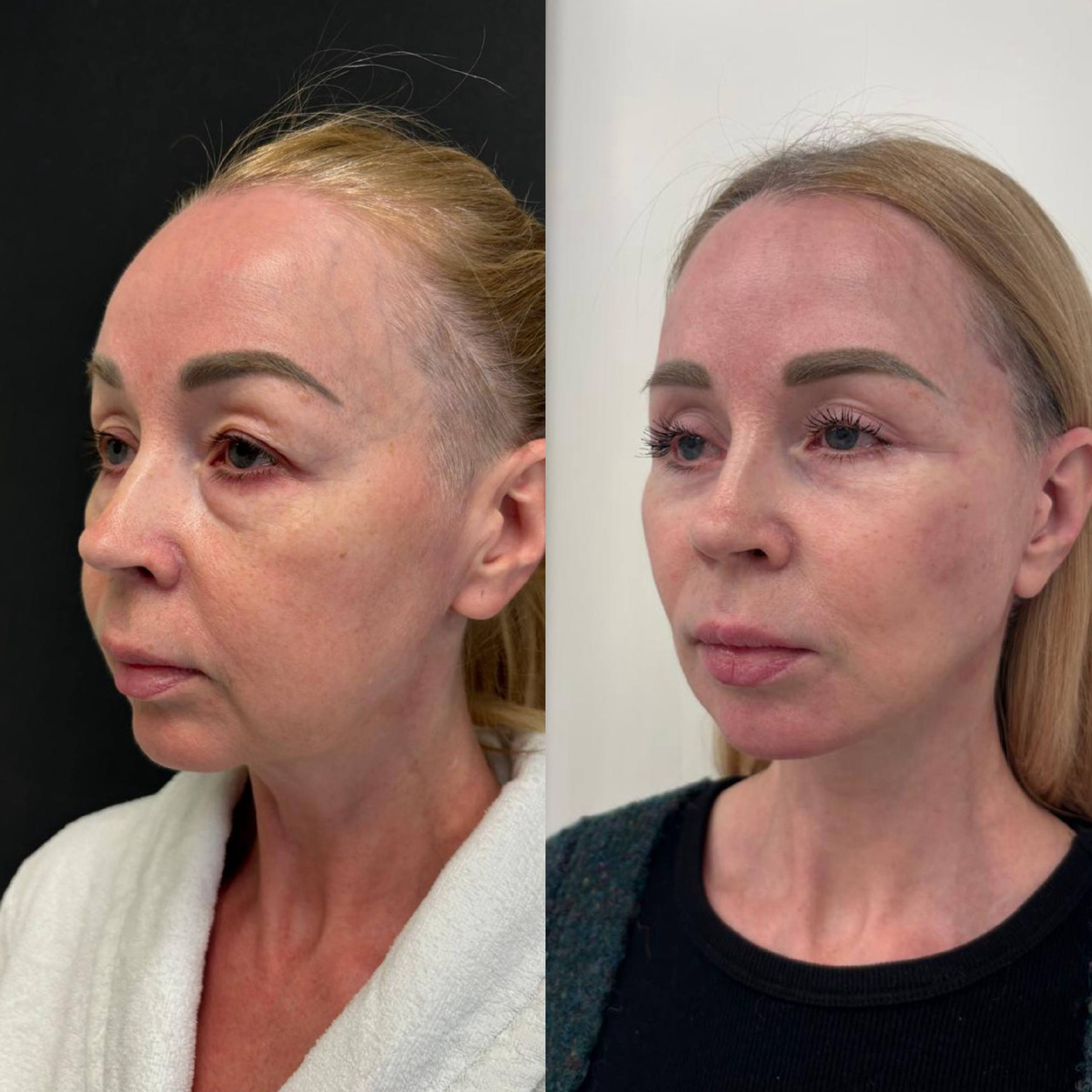 Результат СМАС-лифтинга и квадрилатеральной блефаропластики в исполнении Новосёлова Олега Александровича