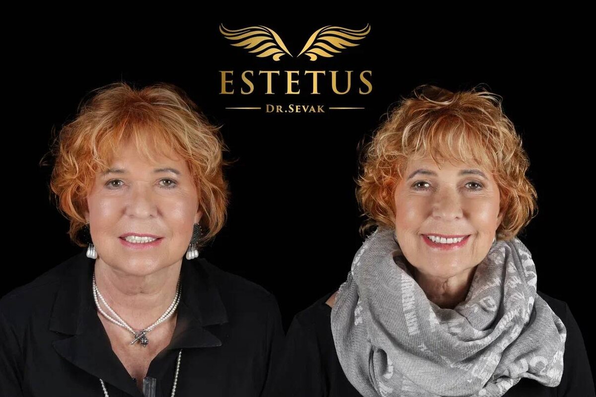 Илона, пациентка клиники доктора Севака Estetus
