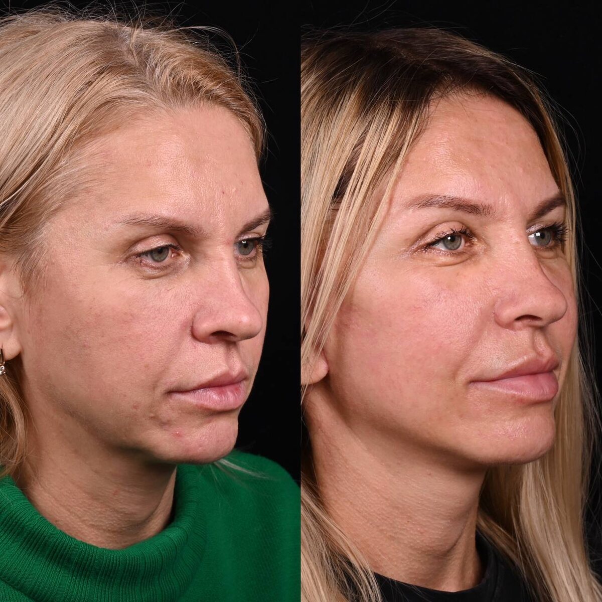 Липофилинг верхних век. Фото до и после. Фото с сайта хирурга Д.Р. Гришкяна. Имеются противопоказания, требуется консультация специалиста.