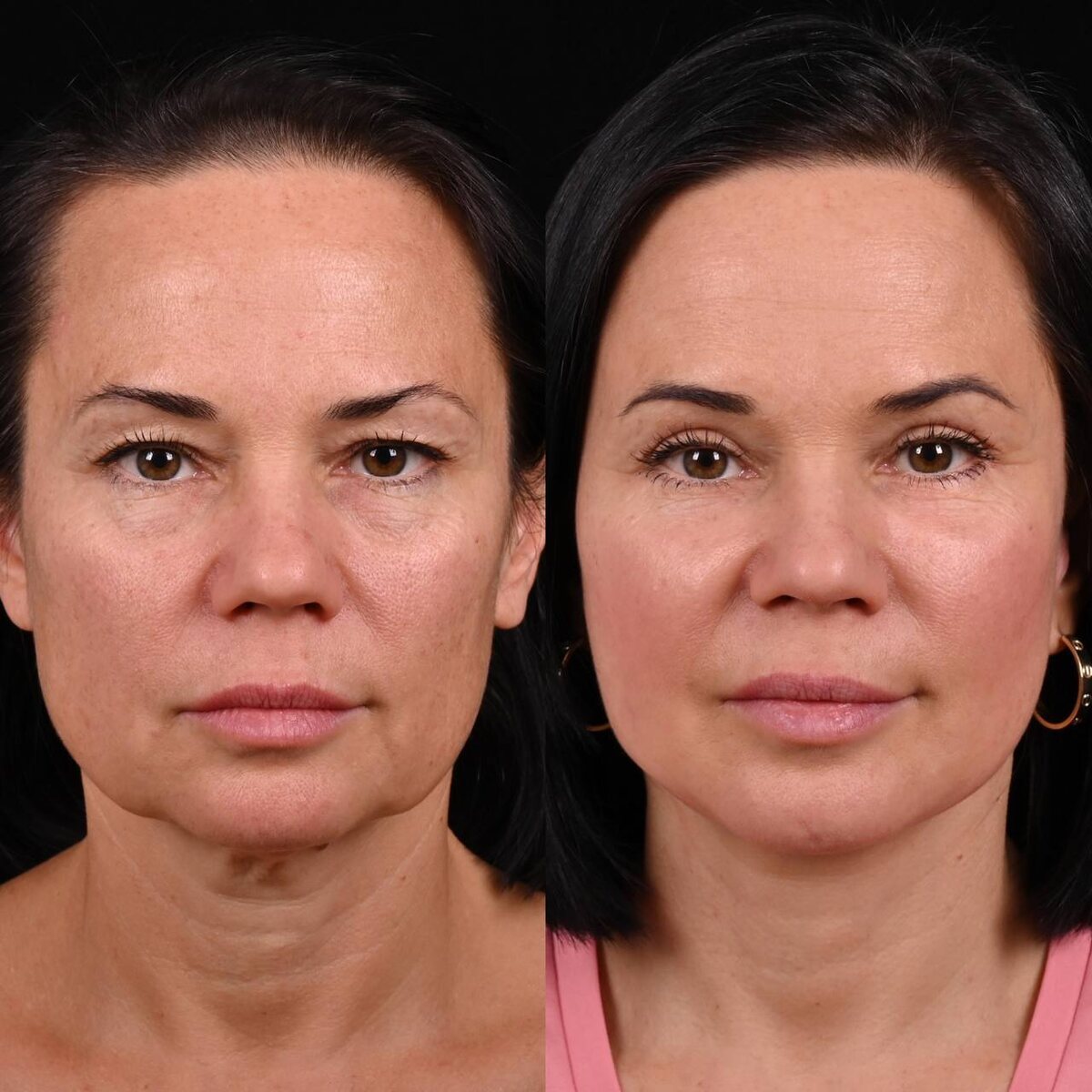 Трансконъюктивальная блефаропластика, пластика центральной части шеи, пластика лица и шеи макс-лифт стандарт, пластика вехних век.  Фото до и после. Фото с сайта хирурга Д.Р. Гришкяна. Имеются противопоказания, требуется консультация специалиста.