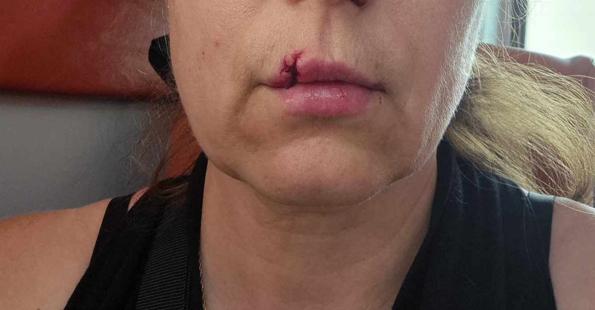 до ушивания, сижу в карете скорой после инцидента... фото для следователя и мужа