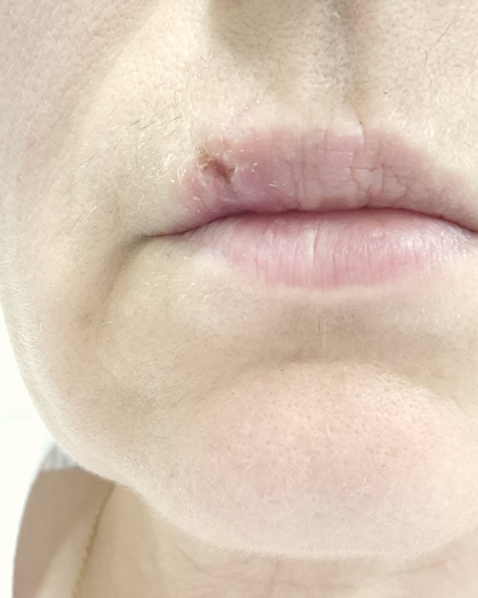 результата через 2 недели и снятия швов