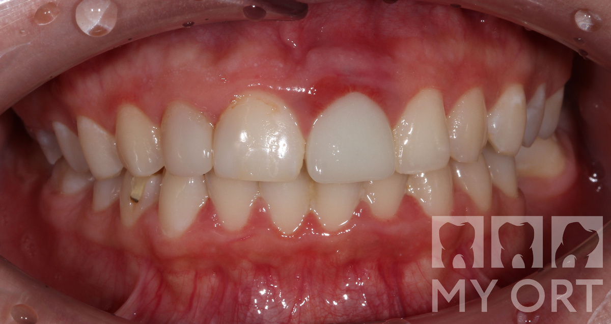 Ситуация до лечения. Зуб под коронкой сильно разрушен, видно воспаление