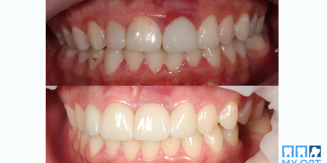 Как мы лечили подвижность коронки и воспаление десны, а в итоге пришли к полной трансформации улыбки