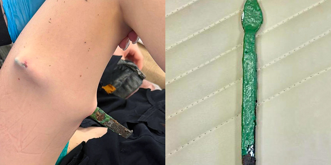 В Москве врачи извлекли из ребенка часть школьного железного забора