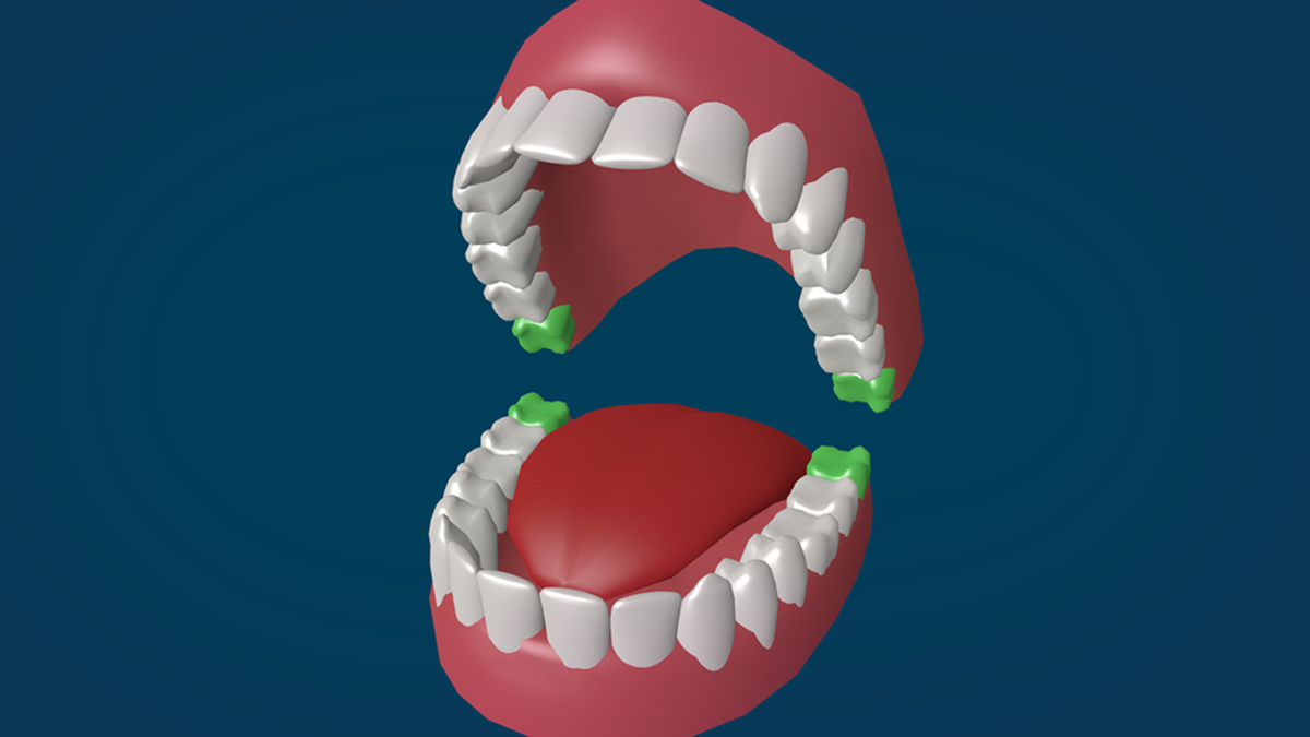 Наверное, все представляют себе, что такое зубы мудрости