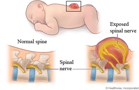 Spina bifida — это врождённый дефект развития нервной трубки, структуры, из которой на ранних сроках беременности формируются спинной и головной мозг. При этом состоянии позвоночник ребёнка закрывается не полностью, из-за чего часть спинного мозга или нервных тканей может оставаться незащищённой. Тяжесть нарушения бывает разной: от почти незаметных форм до серьёзных неврологических нарушений, влияющих на движение, чувствительность и работу внутренних органов. Исследования показывают, что достаточное потребление фолатов в первые недели беременности значительно снижает риск развития spina bifida, поэтому фолиевая кислота считается одним из наиболее изученных и доказанных нутриентов в профилактике дефектов нервной трубки.