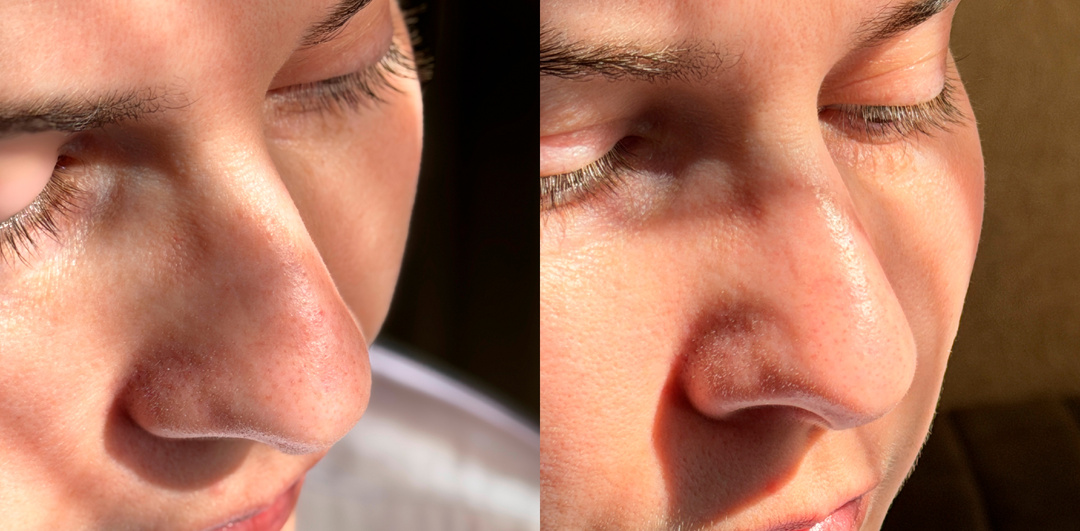 Простой и быстрый способ избавиться от черных точек. Достаточно одного умывания