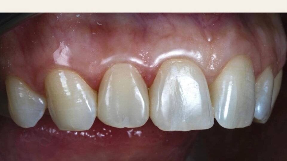 К нам обратился пациент с запросом: его не устраивал внешний вид зубов — неровности и трещины на эмали