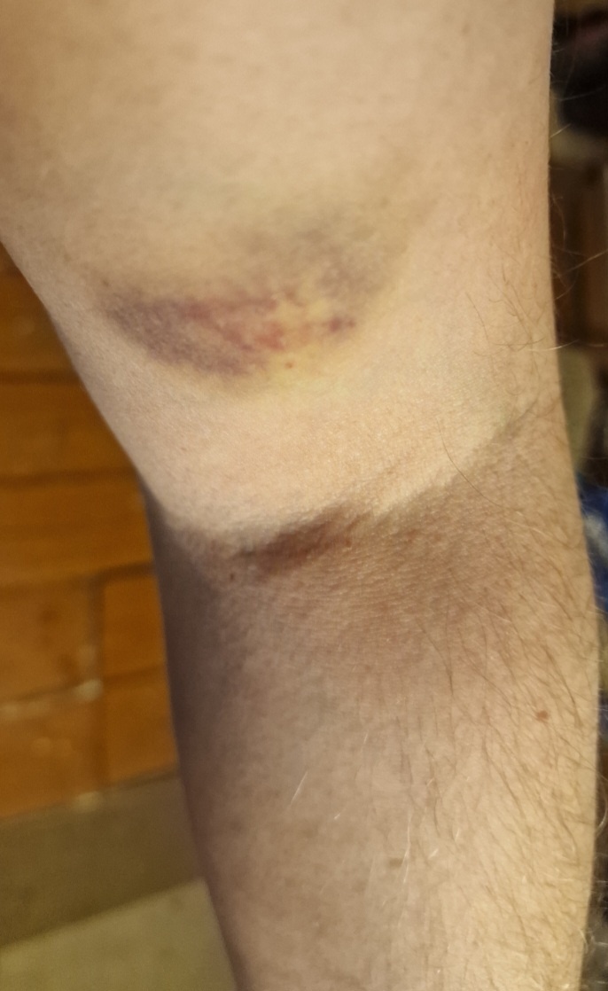 В частности на плече, это называлось: "Ой, не получается здесь. Давайте на запястьи!"( А я, блин, говорил им, что на локтевом сгибе нефиг "ловить"!!!)