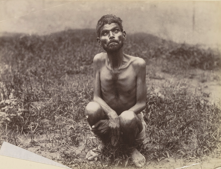 Дина Саничар — один из самых известных случаев «одичавшего ребёнка». Он прожил среди людей десятки лет, но так и не смог вернуться к нормальной человеческой жизни.