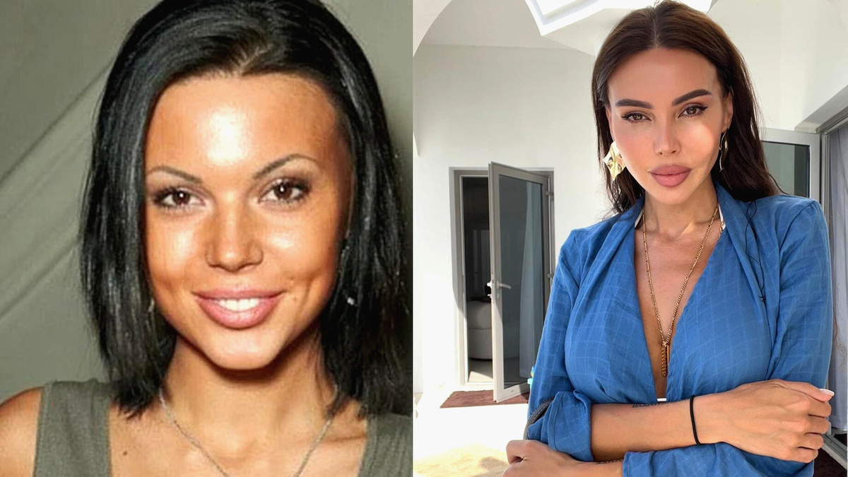 Фото из открытого доступа. До и после пластики.