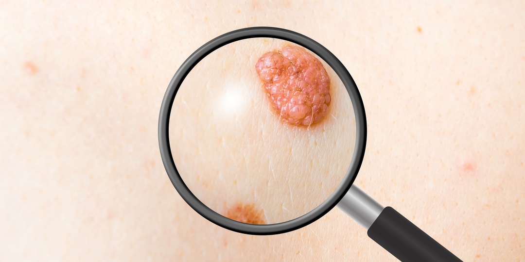 7 изменений кожи, которые могут указывать на новообразования
