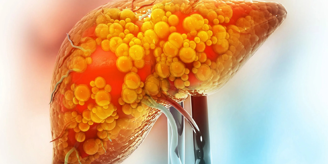 Питание против жира в печени: как почистить печень без таблеток и диет