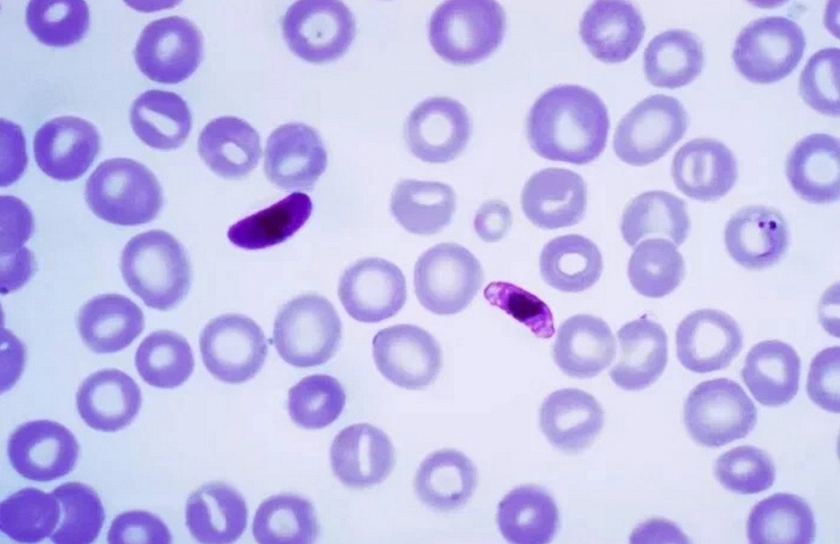    Мазок крови с Plasmodium falciparum