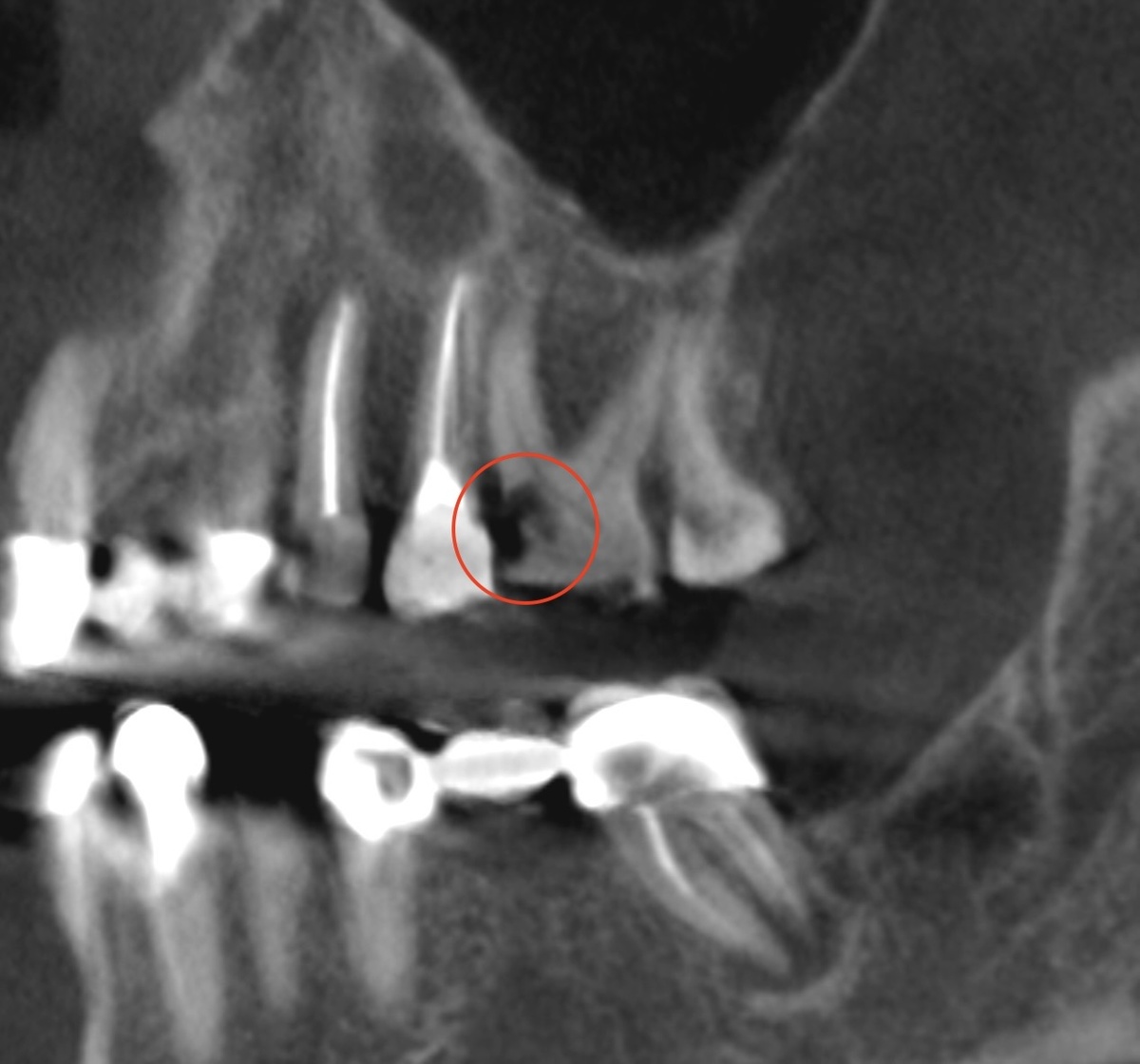 Кариес корня