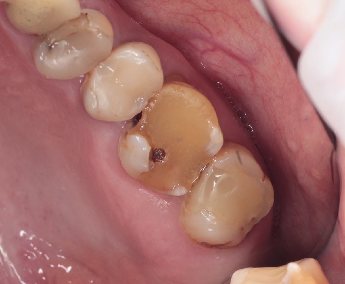 Дефектная пломба с акерным штифтом