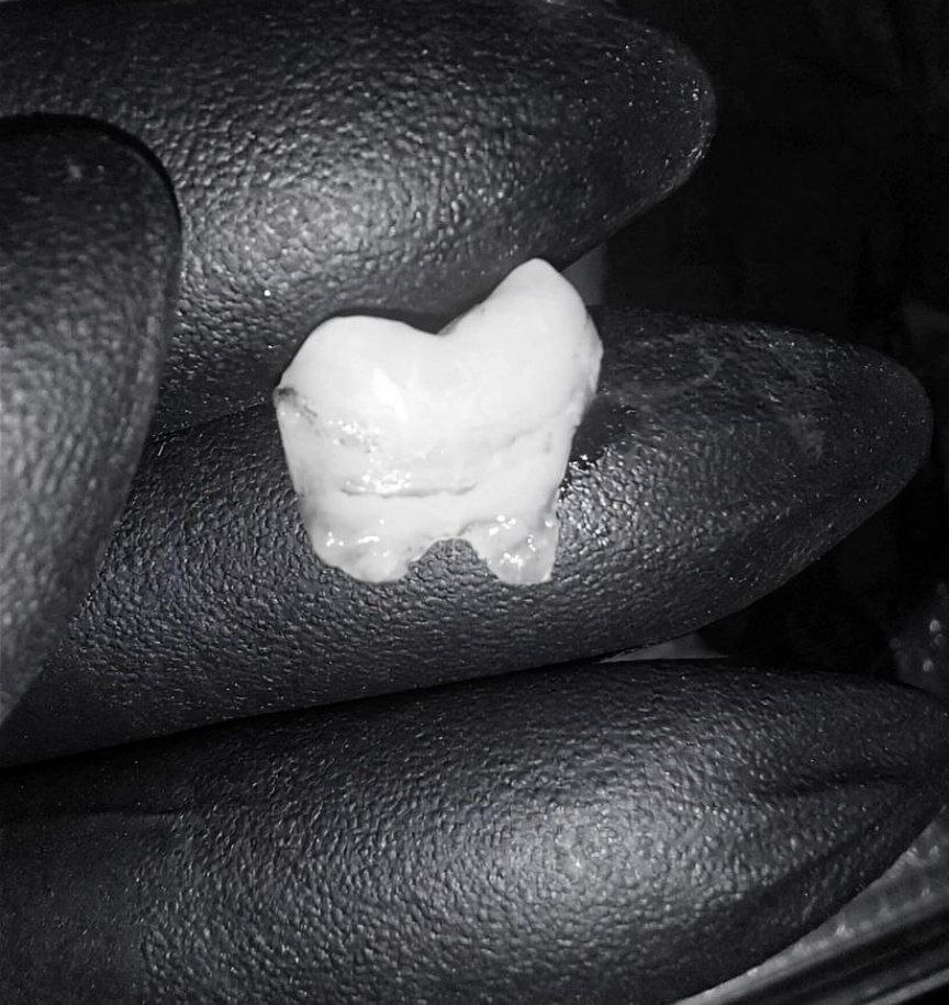 Это я, держу в руке обломок зуба.