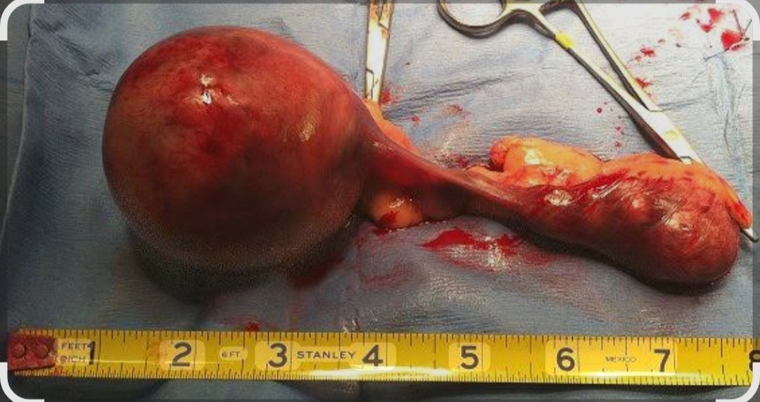 Киста яичников