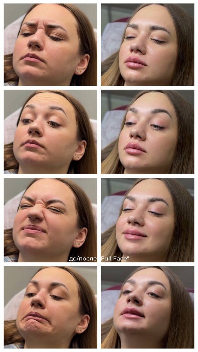 До/после ботулинотерапии фул фейс 