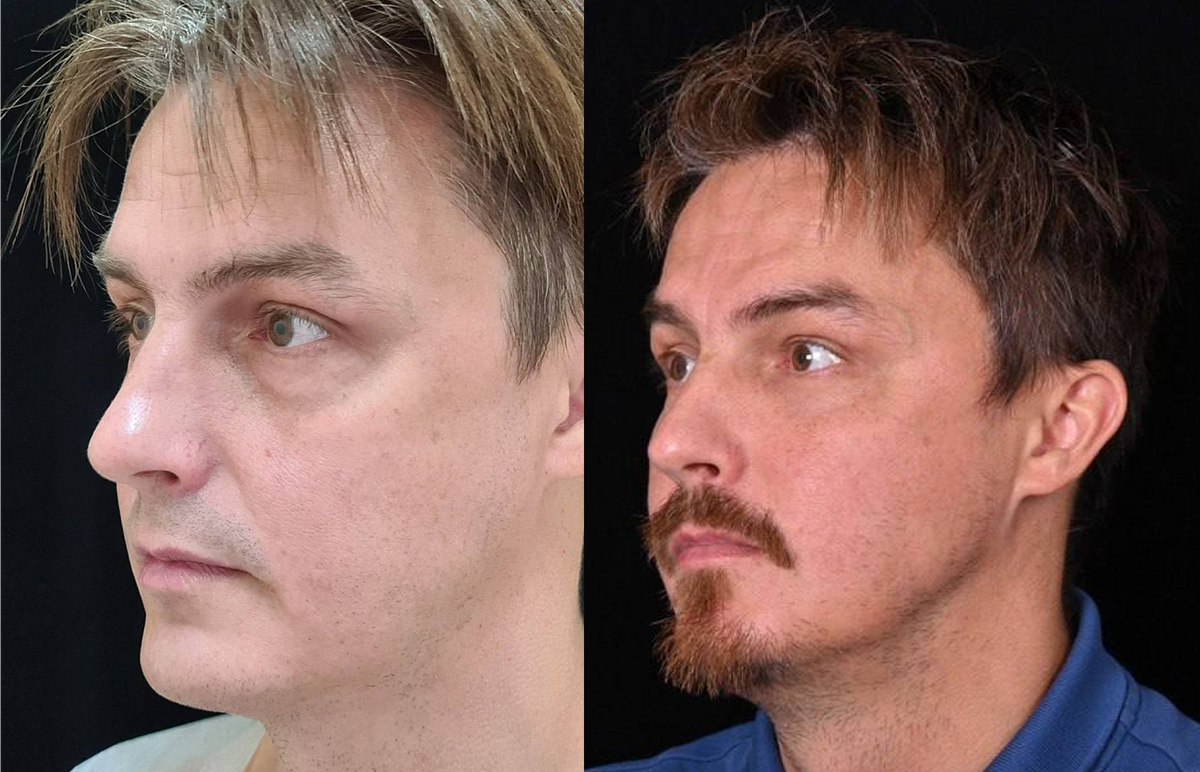 Липофилинг средней зоны и нижних век, щадящая коррекция грыж. Фото до и после. Фото с сайта хирурга Д.Р. Гришкяна. Имеются противопоказания, требуется консультация специалиста.