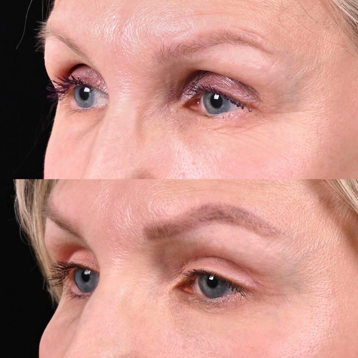 Блефаропластика с понижением борозды и липофилинг. Фото до и после. Фото с сайта хирурга Д.Р. Гришкяна. Имеются противопоказания, требуется консультация специалиста.