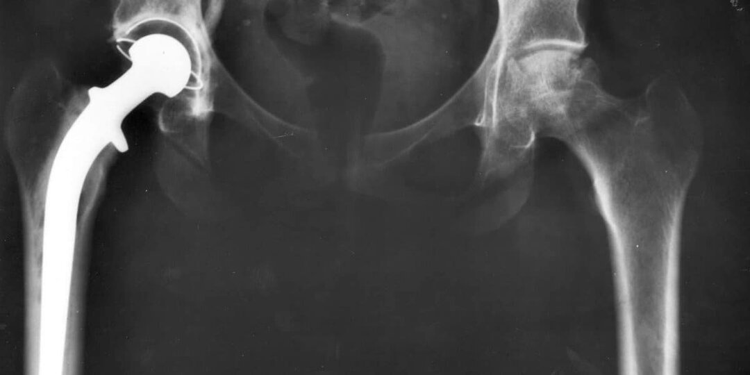 Ученые из России точнее спрогнозировали долговечность протезов
