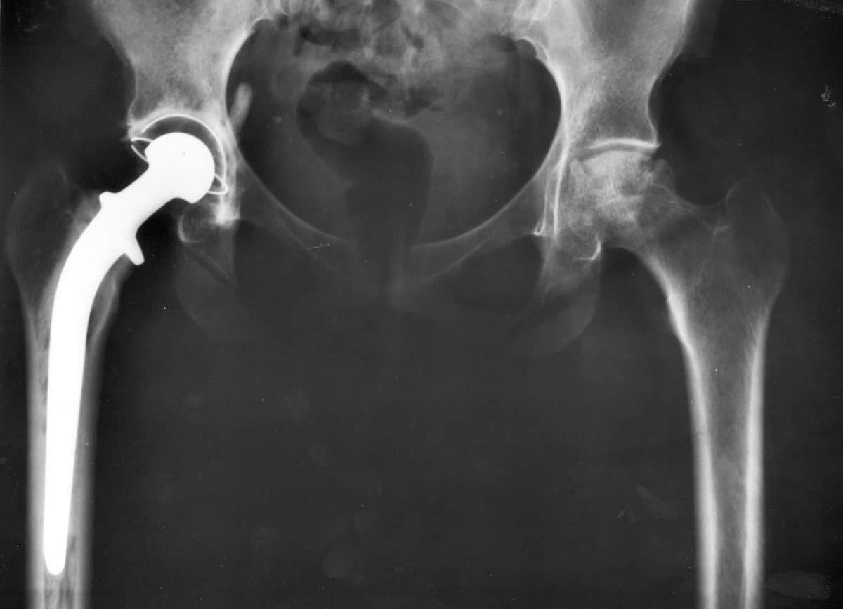    Рентген после эндопротезирования тазобедренного сустава / © NIADDK, 9AO4 (Connie Raab-contact), National Institutes of Health / Wikipedia