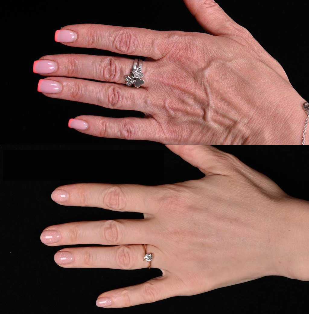 Липофилинг рук. Фото до и после. Фото с сайта хирурга Д.Р. Гришкяна. Имеются противопоказания, требуется консультация специалиста.