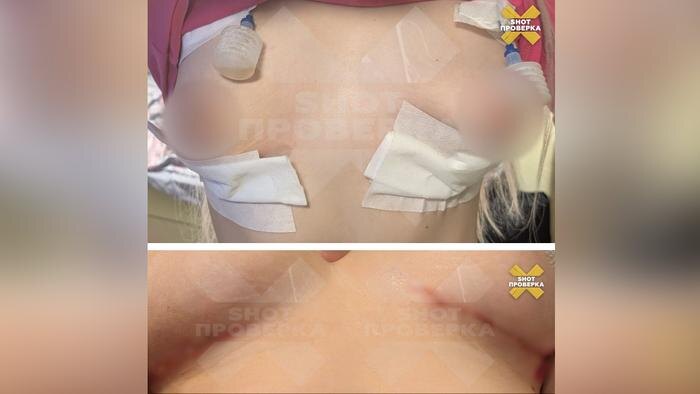 Москвичка хотела увеличить грудь, а получила гной. Фото © Telegram / SHOT ПРОВЕРКА
