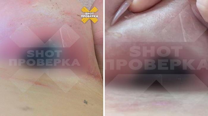 Москвичка хотела увеличить грудь, а получила гной. Фото © Telegram / SHOT ПРОВЕРКА