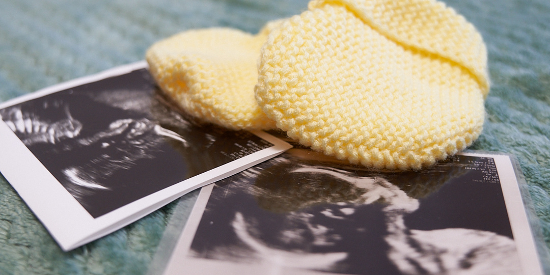 92 свердловчанки сделали аборты, узнав о возможном синдроме Дауна у плода