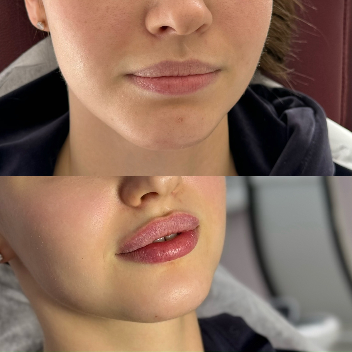 До/после увеличения препаратом Stylage m