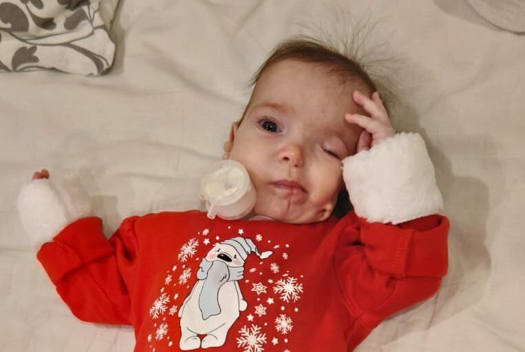 Недоразвитая челюсть и лицо: как синдром Гольденхара изменил жизнь маленькой Марьяны