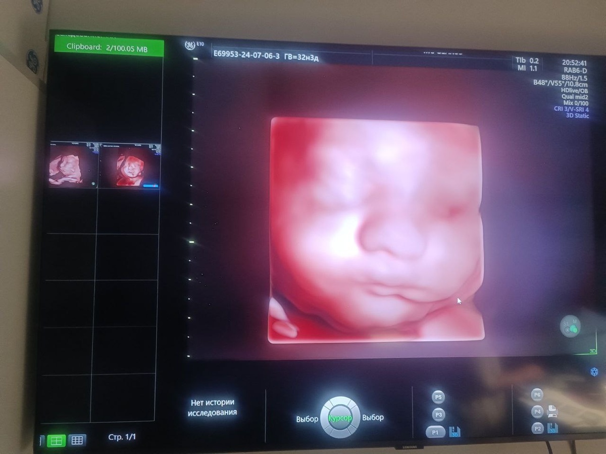 Третье УЗИ во время беременности. Фото из архива героев публикации.