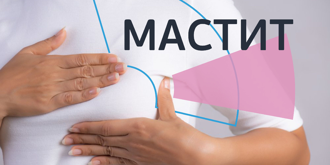 Мастит у женщин. Как не пропустить тревожный сигнал